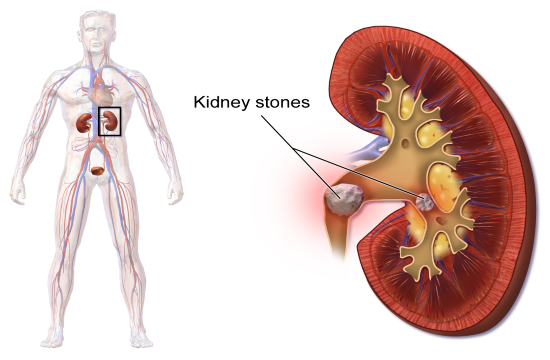 Blausen_0595_KidneyStones_410070606